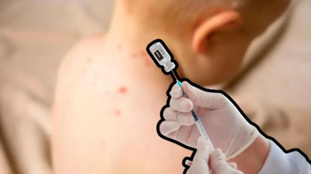 Vacuna contra el sarampión en BCS: dónde acudir para protegerte tras casos recientes