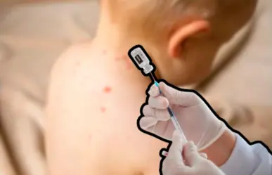 Vacuna contra el sarampión en BCS: dónde acudir para protegerte tras casos recientes