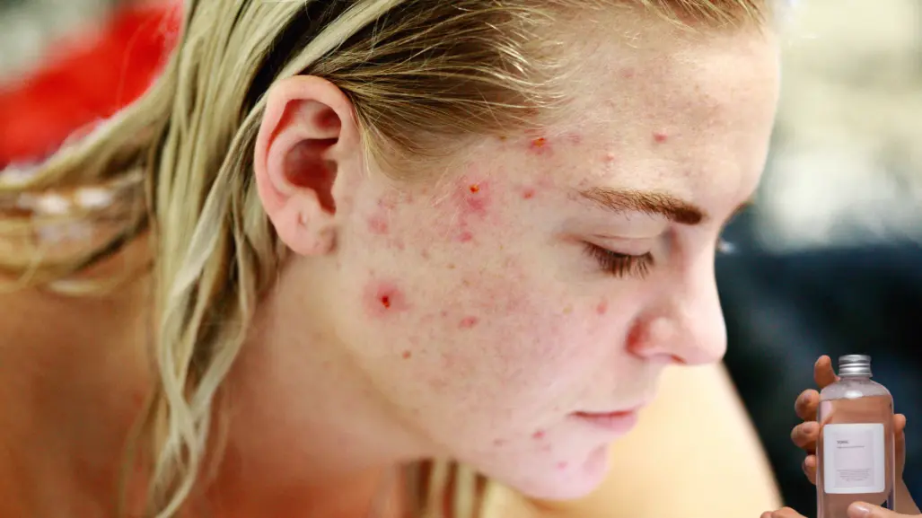 Este tónico con vinagre blanco te ayudará a decirle adiós al acné de tu rostro