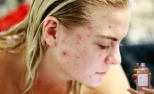 Este tónico con vinagre blanco te ayudará a decirle adiós al acné de tu rostro