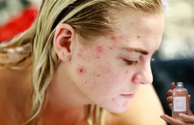 Este tónico con vinagre blanco te ayudará a decirle adiós al acné de tu rostro