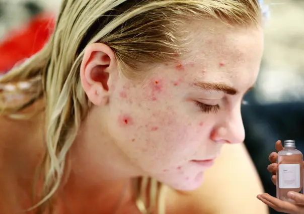 Este tónico con vinagre blanco te ayudará a decirle adiós al acné de tu rostro