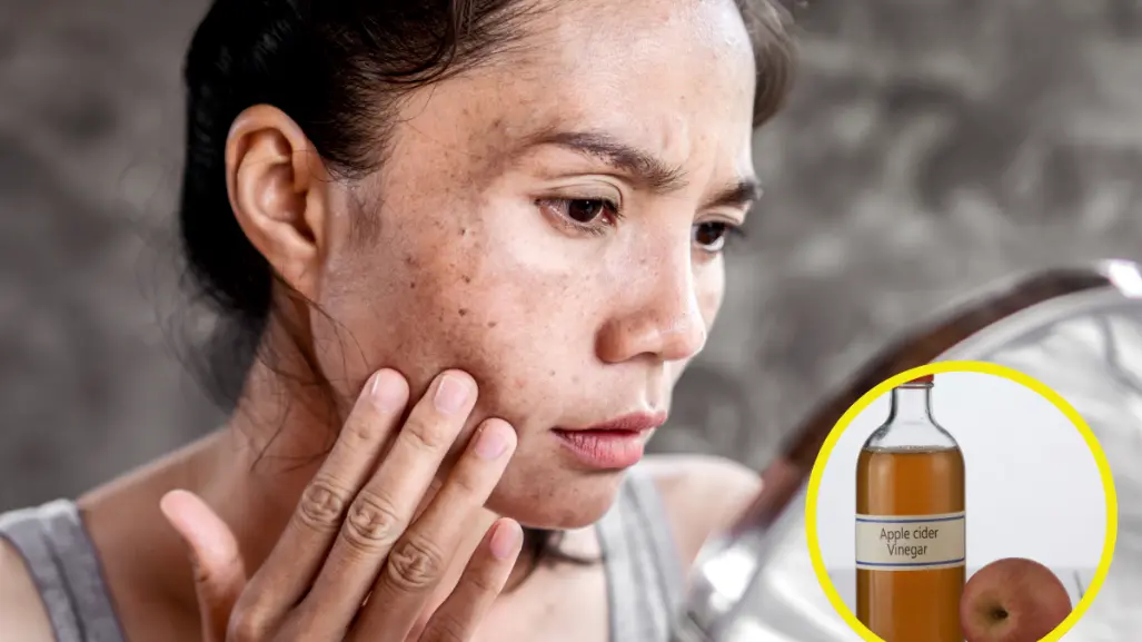 ¿Tienes manchas en el rostro? Elíminalas con este truco con vinagre