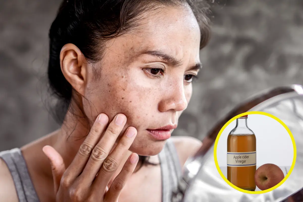 El vinagre de manzana tiene un compuesto que ayuda a eliminar las manchas oscuras del rostro. Foto: Canva