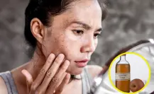 ¿Tienes manchas en el rostro? Elíminalas con este truco con vinagre