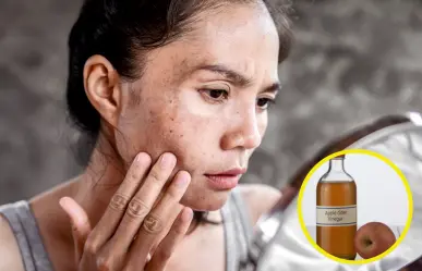 ¿Tienes manchas en el rostro? Elíminalas con este truco con vinagre