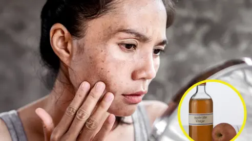 ¿Tienes manchas en el rostro? Elíminalas con este truco con vinagre