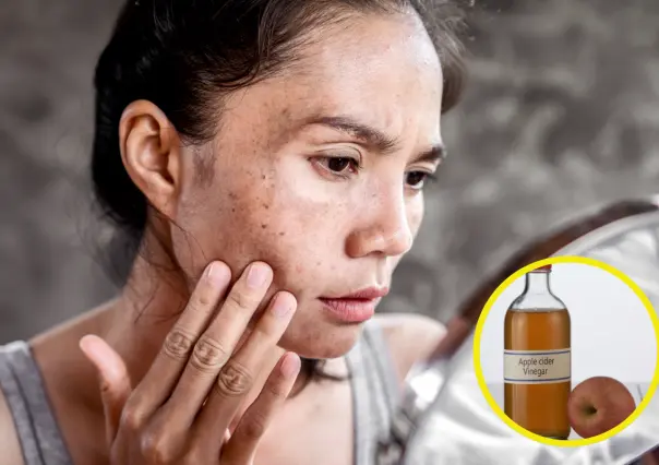 ¿Tienes manchas en el rostro? Elíminalas con este truco con vinagre