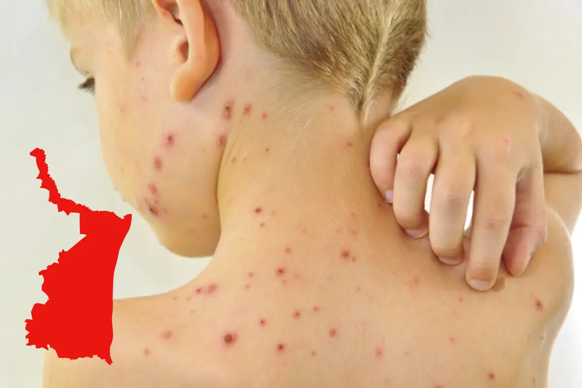 El virus afecta principalmente a la población infantil y ha motivado un refuerzo de la vigilancia epidemiológica en planteles educativos. Foto: Posta Tamaulipas