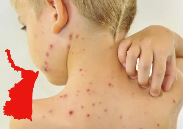 Tamaulipas en el top 5 nacional con más contagios de varicela