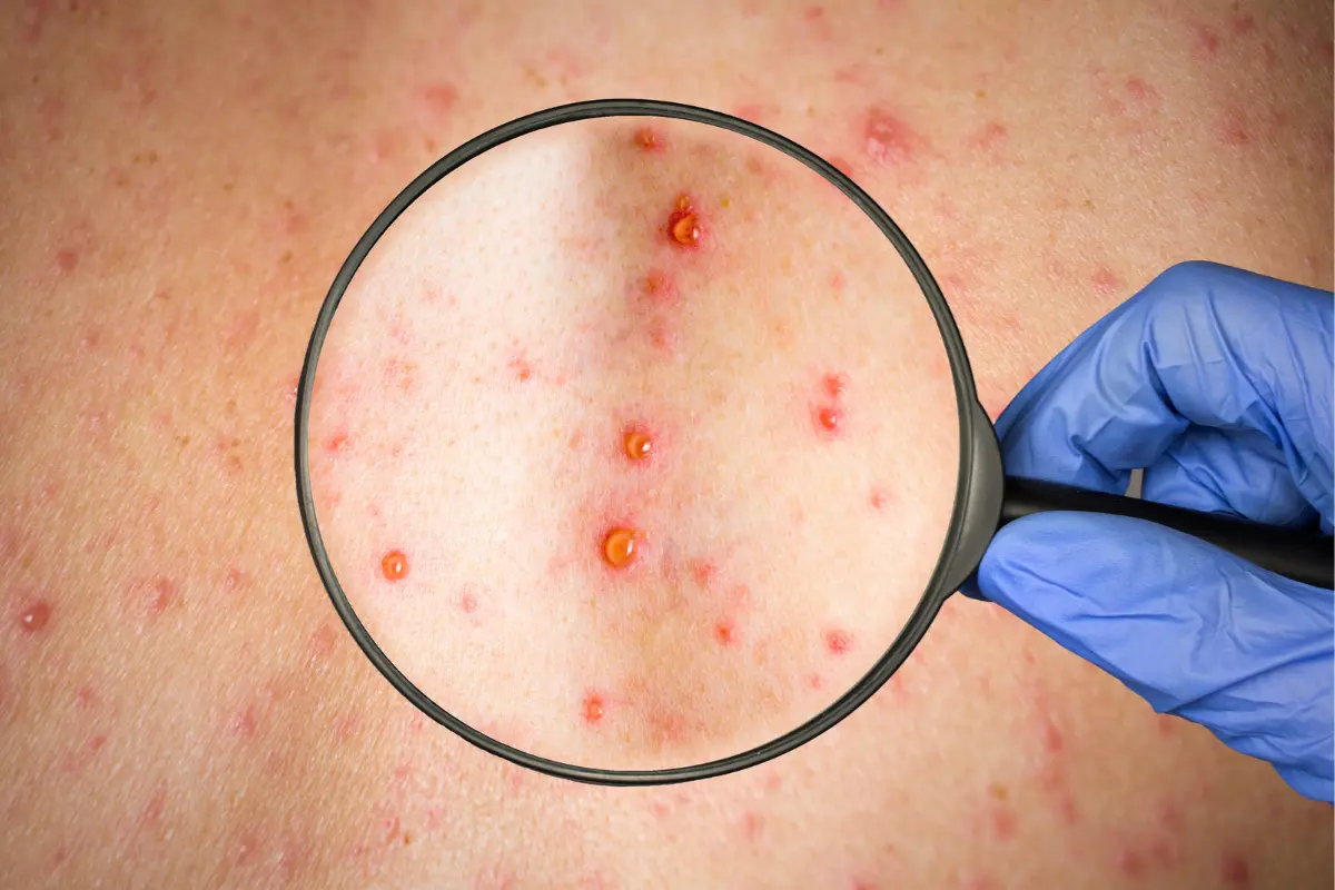 Aunque la mayoría de las personas la padece solo una vez, el virus permanece en el cuerpo y puede reactivarse en la adultez en forma de herpes zóster. Foto: CANVA
