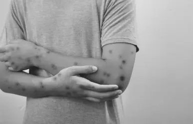 Secretario de Salud de confirma la primera muerte por Mpox en Jalisco 