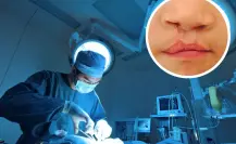 DIF Saltillo ofrece cirugías gratuitas para personas con labio y paladar hendido