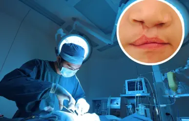 DIF Saltillo ofrece cirugías gratuitas para personas con labio y paladar hendido