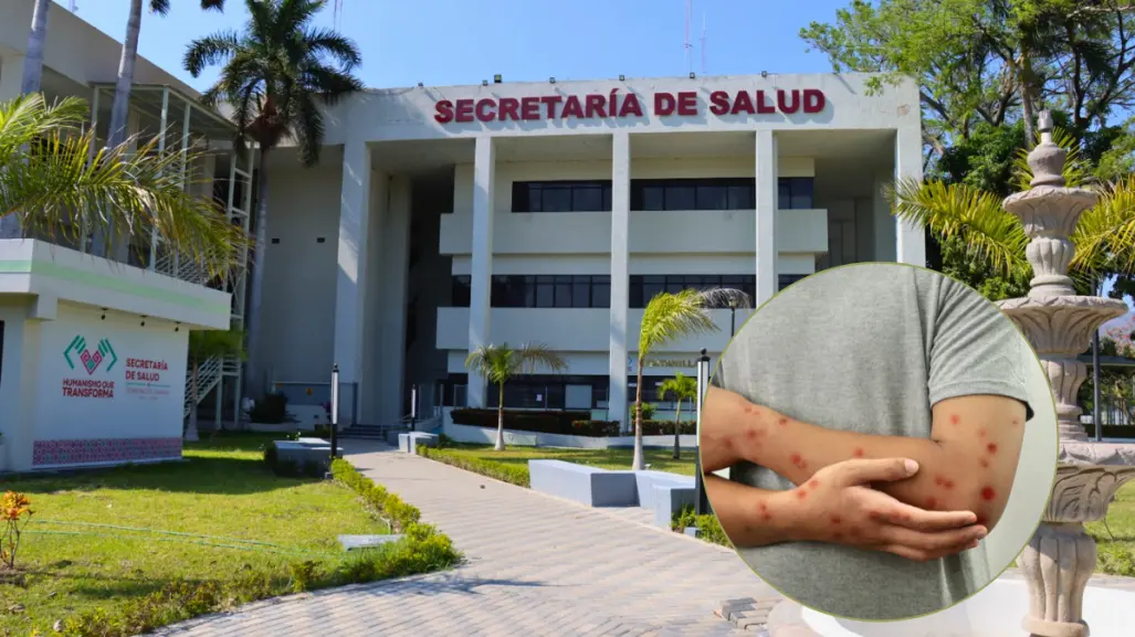 Confirman caso de Mpox en paciente hospitalizado en Chiapas