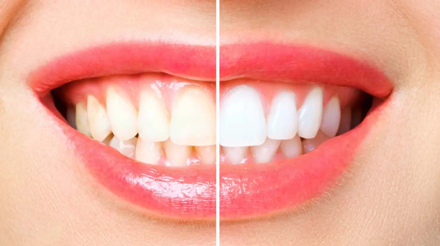 El mejor remedio casero para blanquear tus dientes y lucir una sonrisa más brillante. Foto: Canva.