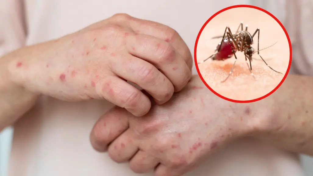 Tamaulipas fortalece acciones contra el dengue y el sarampión