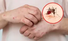 Tamaulipas fortalece acciones contra el dengue y el sarampión