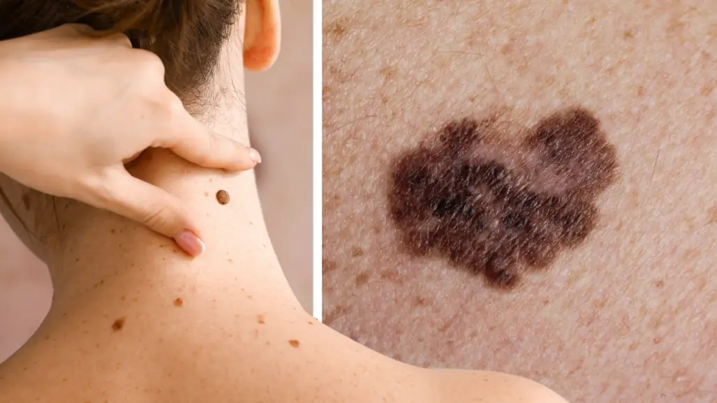 ¿Lunar o melanoma? Así puedes identificarlo en casa con este sencillo método