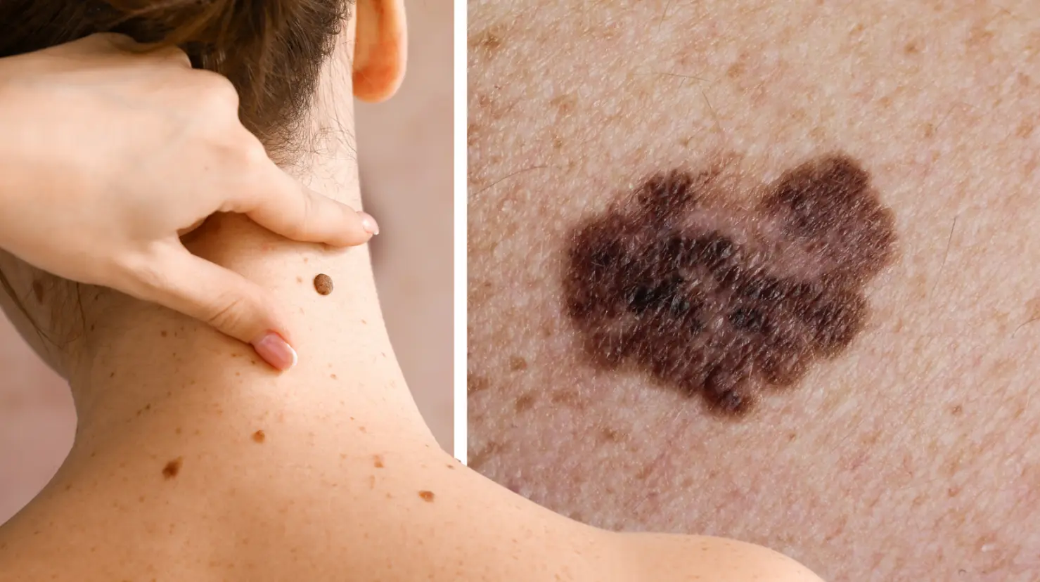 ¿Lunar o melanoma? Así puedes identificarlo en casa con este sencillo método. Foto: Canva.