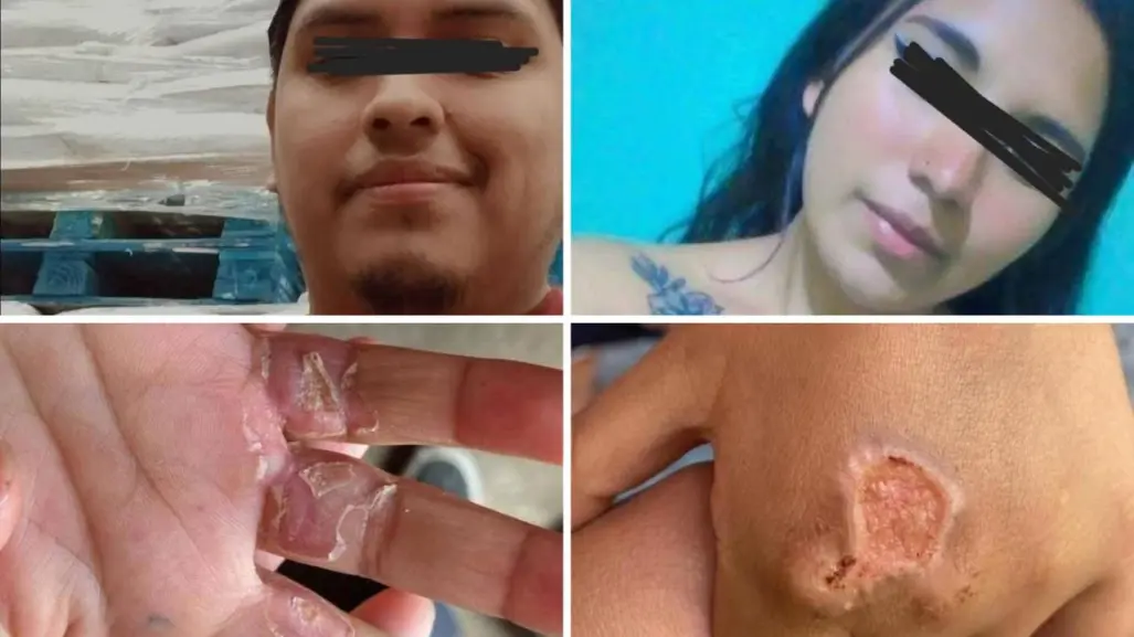 Padrastro castiga con quemaduras a dos niños de 4 y 6 años en Edomex