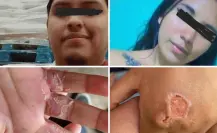 Padrastro castiga con quemaduras a dos niños de 4 y 6 años en Edomex