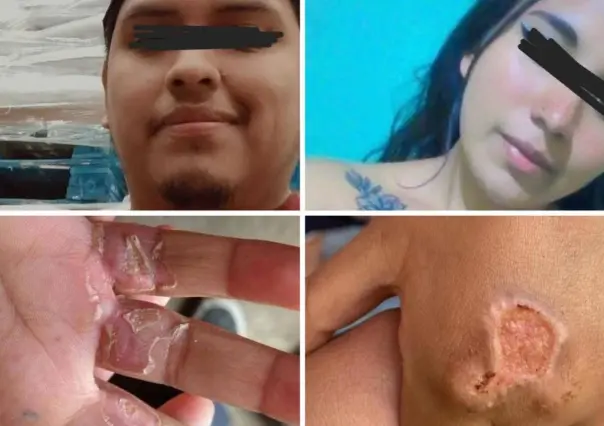 Padrastro castiga con quemaduras a dos niños de 4 y 6 años en Edomex