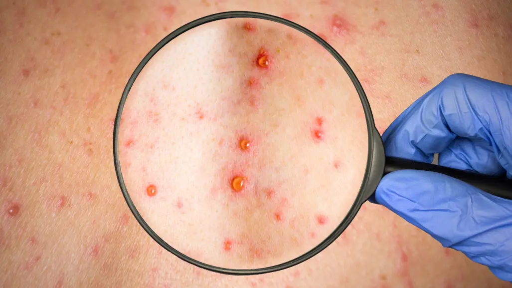 Esta enfermedad contagiosa con más de 600 pacientes en Durango es muy peligrosa para los adultos
