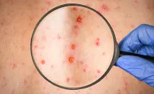 Esta enfermedad contagiosa con más de 600 pacientes en Durango es muy peligrosa para los adultos