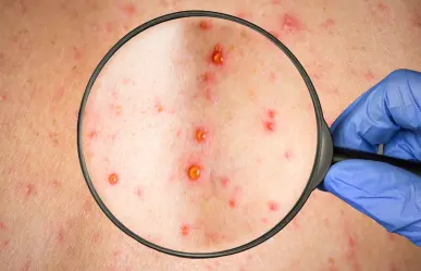 Esta enfermedad contagiosa con más de 600 pacientes en Durango es muy peligrosa para los adultos