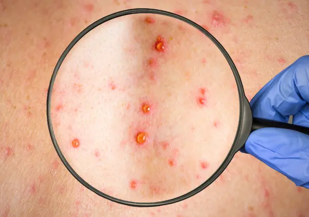 Esta enfermedad contagiosa con más de 600 pacientes en Durango es muy peligrosa para los adultos