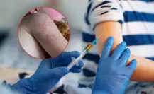 17 fallecimientos y más de 4 mil casos de sarampión en México; Chihuahua concentra el 95% de los contagios