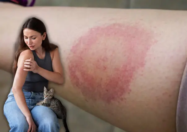 IMSS Nuevo León lanza alerta por rickettsiosis: síntomas y medidas de prevención