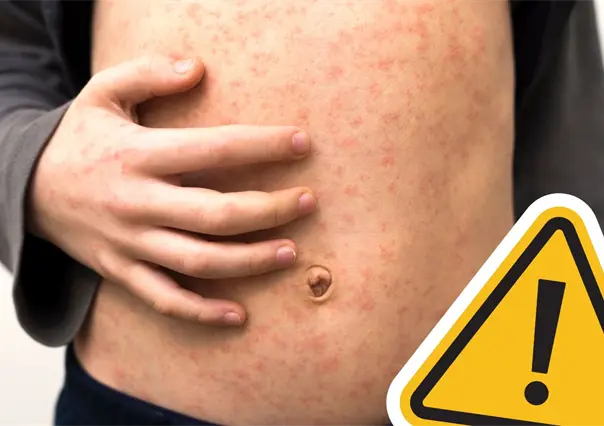 Coahuila se sobrepone al sarampión; registran 54 casos hasta hoy