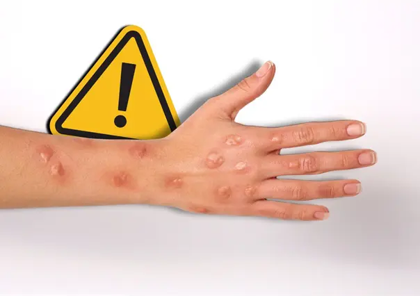 Saltillo en alerta tras caso latente de viruela del mono, esperan confirmación de CDMX