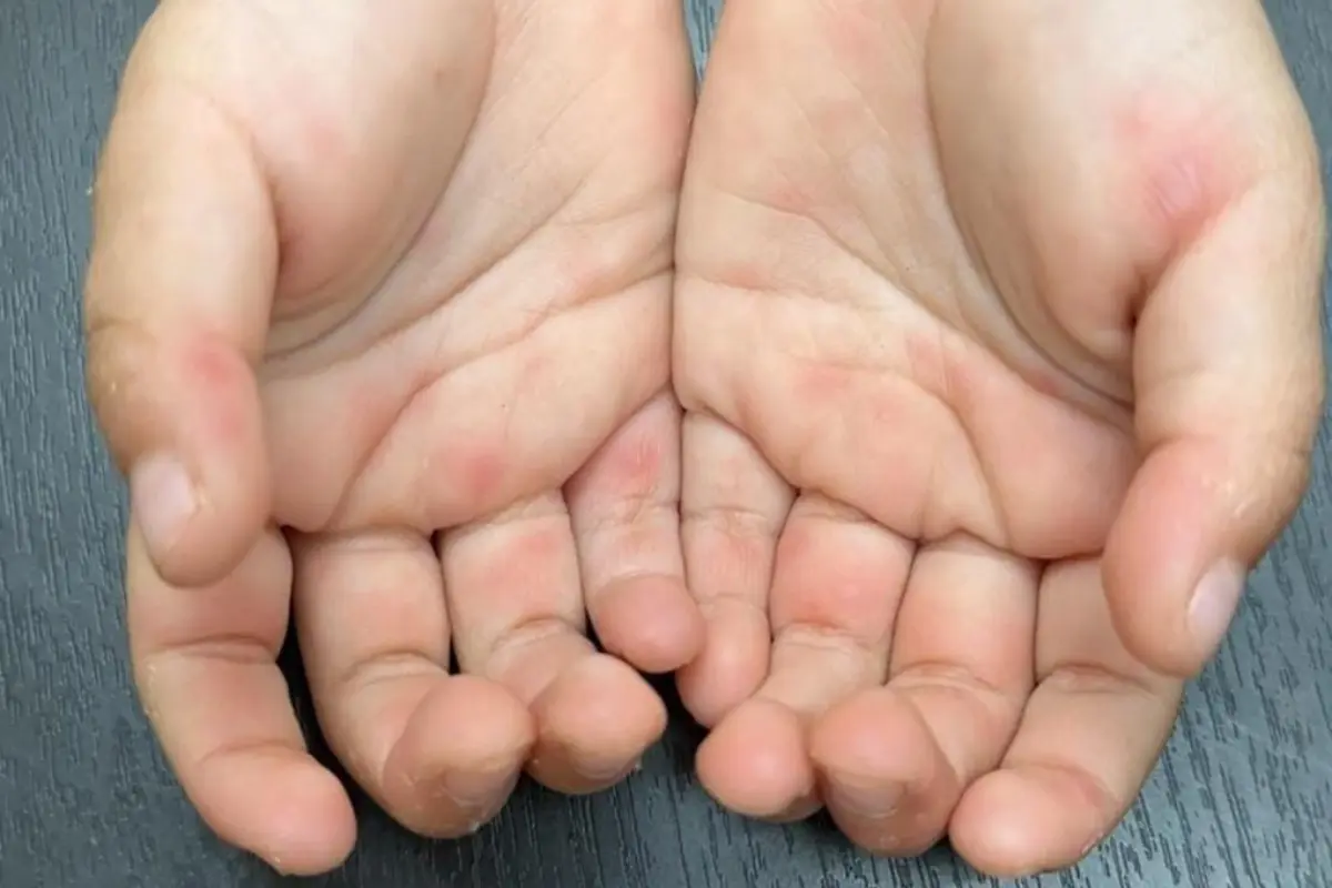 El objetivo es cortar la cadena de contagios y proteger a los menores, ya que esta enfermedad viral no cuenta con una vacuna y se propaga con rapidez. Foto: Freepik