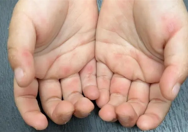 Guarderías del sur de Tamaulipas cierran tras brote de virus en manos y pies