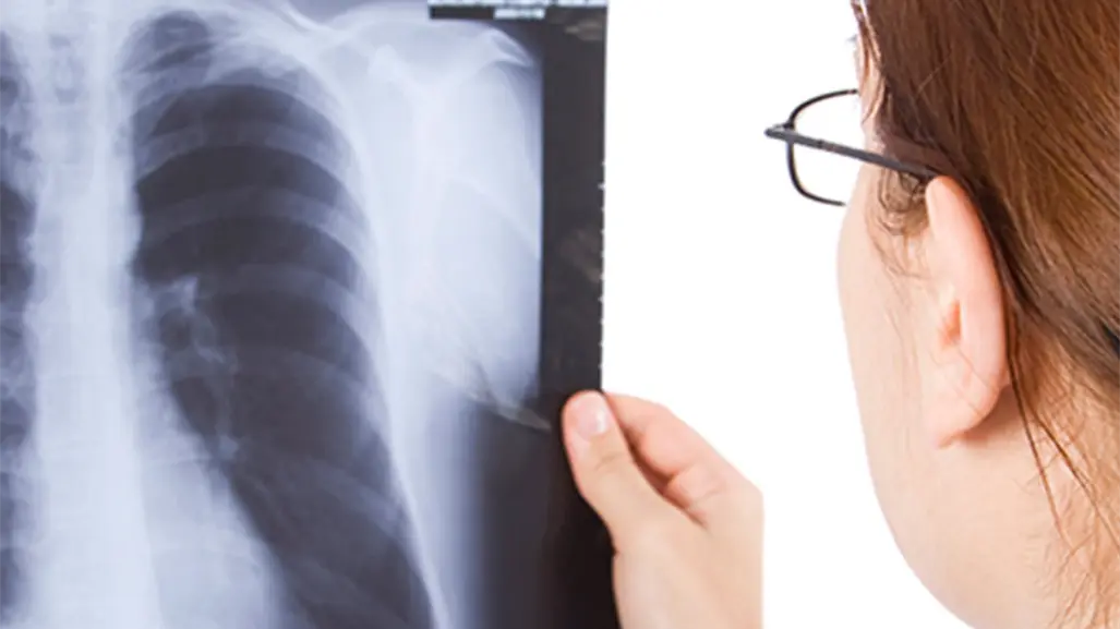 Salud activa alerta epidemiológica por 8 casos de tuberculosis en Tampico