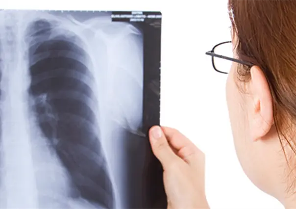 Salud activa alerta epidemiológica por 8 casos de tuberculosis en Tampico
