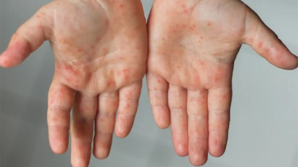 Alertan en Reynosa por presencia del virus "Manos, Pies y Boca" en menores