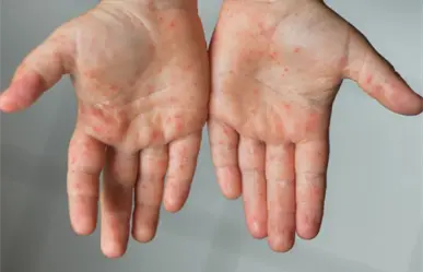 Alertan en Reynosa por presencia del virus "Manos, Pies y Boca" en menores