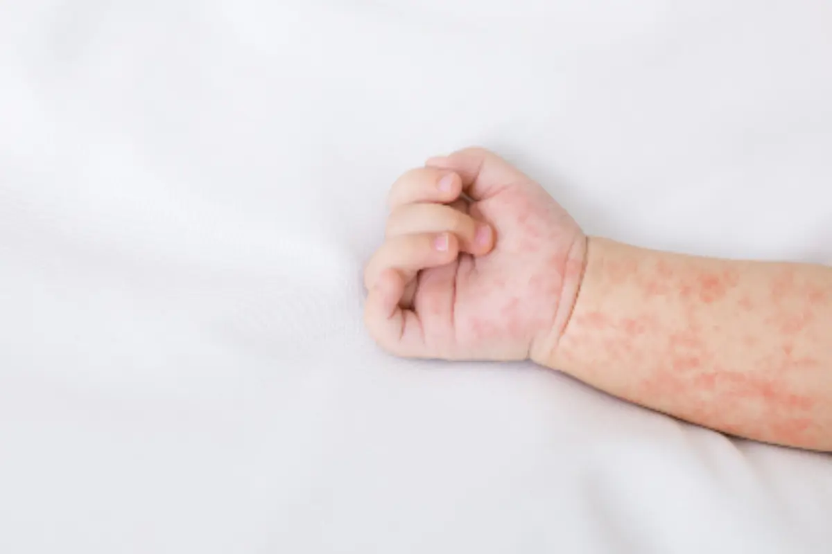 La enfermedad de manos, pies y boca es provocada por el virus Coxsackie y ataca principalmente a niñas y niños. Foto: Carlos García
