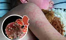 Coahuila entre los estados con más casos de sarampión; Salud Federal confirma 55 contagios.
