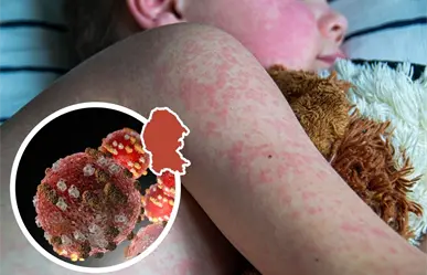 Coahuila entre los estados con más casos de sarampión; Salud Federal confirma 55 contagios.