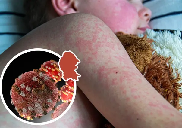 Coahuila entre los estados con más casos de sarampión; Salud Federal confirma 55 contagios.