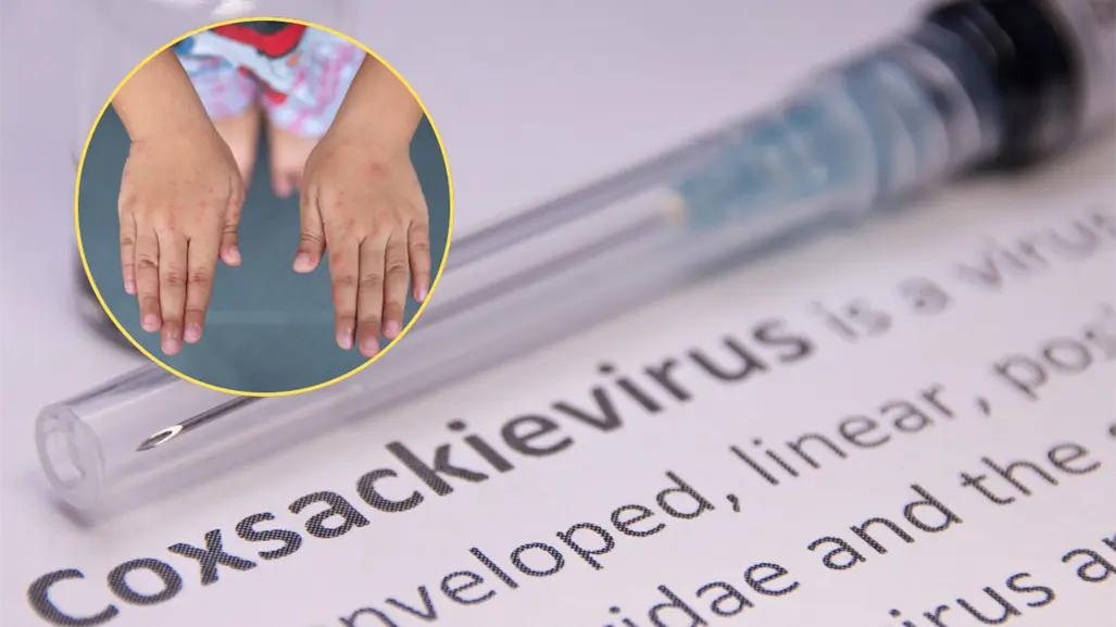 Manos, pies y boca: el virus que causa suspensión de clases en Baja California