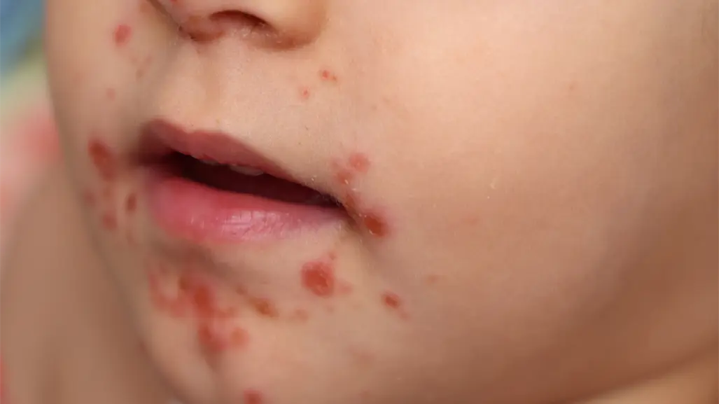 Detectan primer caso del virus Coxsackie en jardín de niños de Matamoros