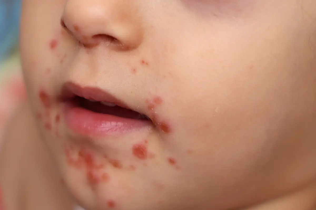 La enfermedad de mano-pie-boca provocada por el virus Coxsackie afecta principalmente a niñas y niños. Foto: Canva