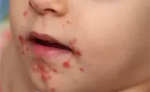 Detectan primer caso del virus Coxsackie en jardín de niños de Matamoros