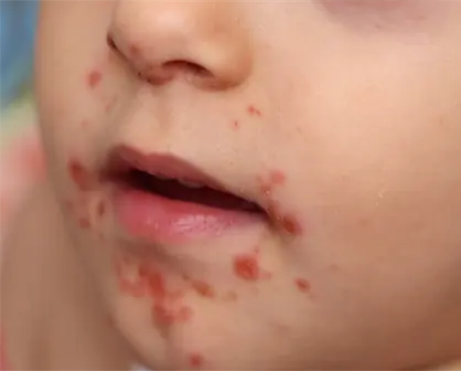 Detectan primer caso del virus Coxsackie en jardín de niños de Matamoros